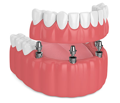 Implant-supported partial dentures