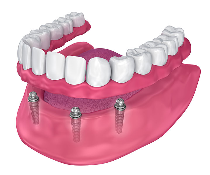 Dental Implant dentures