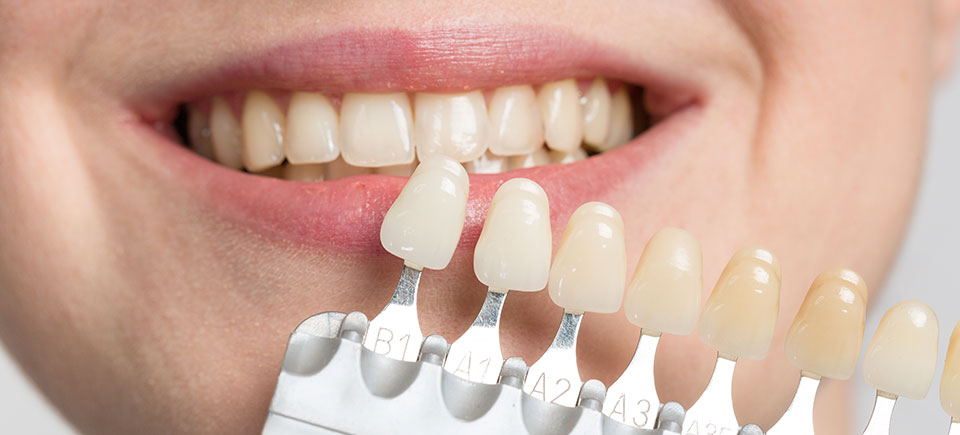 Teeth Whitening with Dental Crown